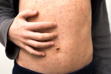 Australia's number of measles cases continues to grow